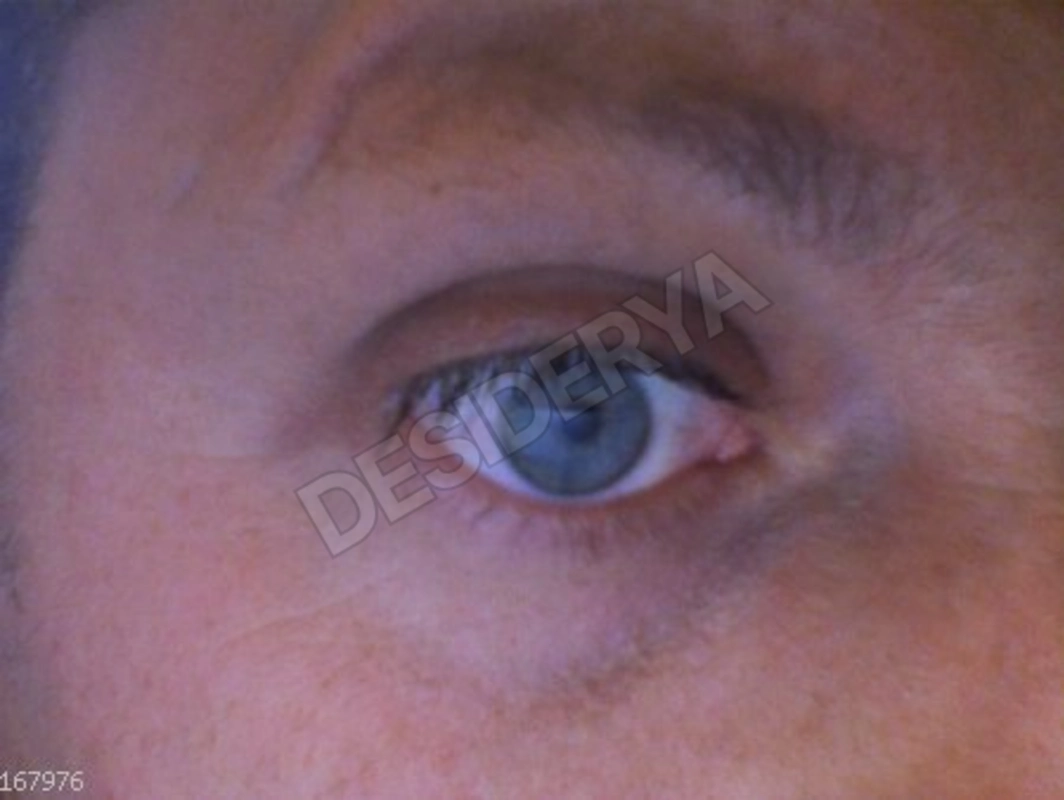 eyeice735381691