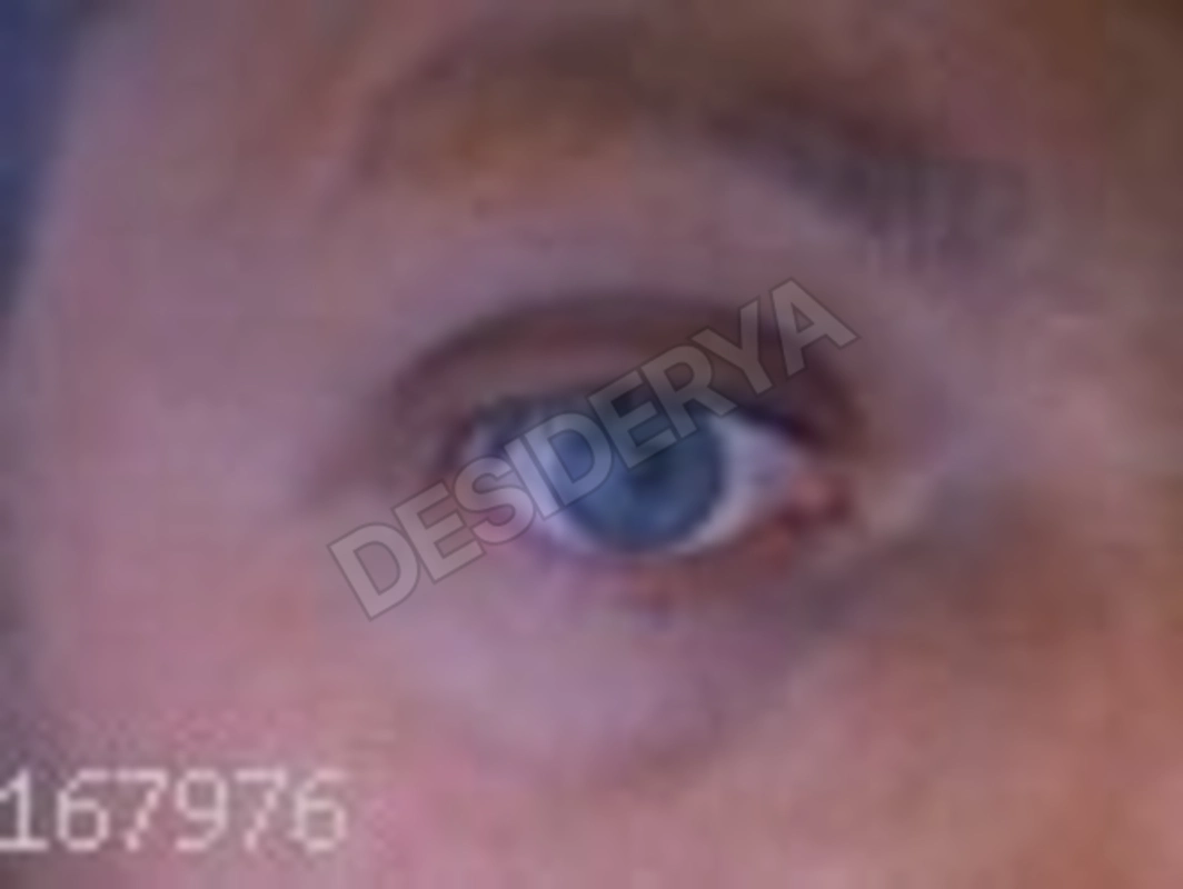 eyeice735381688